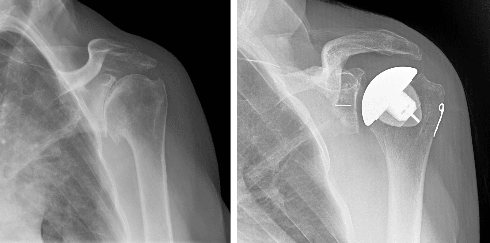 Shoulder X-ray
